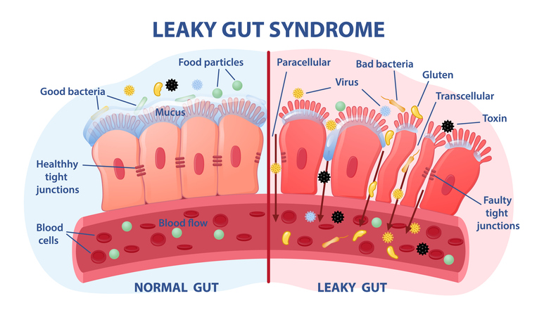 Leaky gut nutritionist twickenham